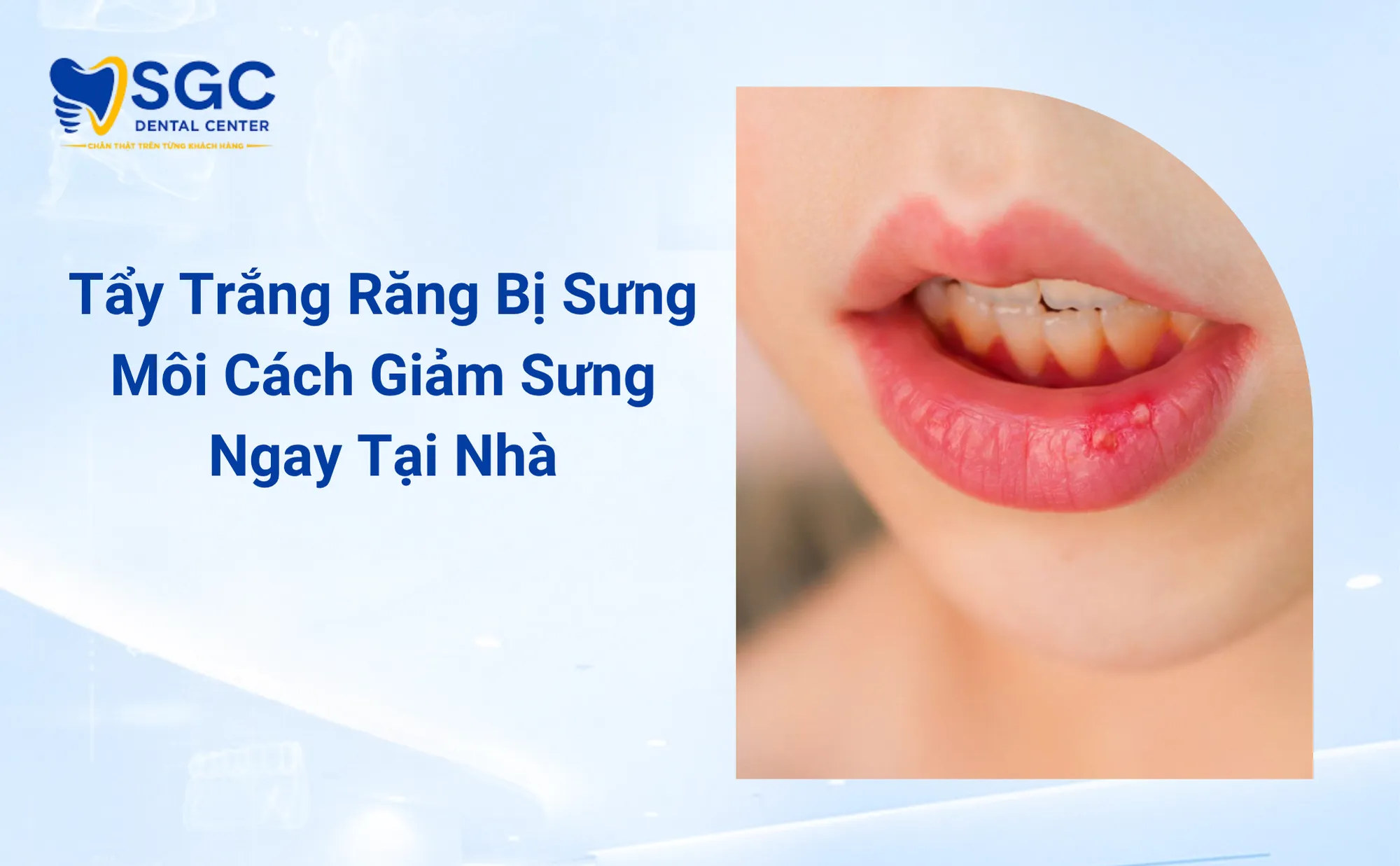 Tẩy Trắng Răng Bị Sưng Môi Cách Giảm Sưng Ngay Tại Nhà