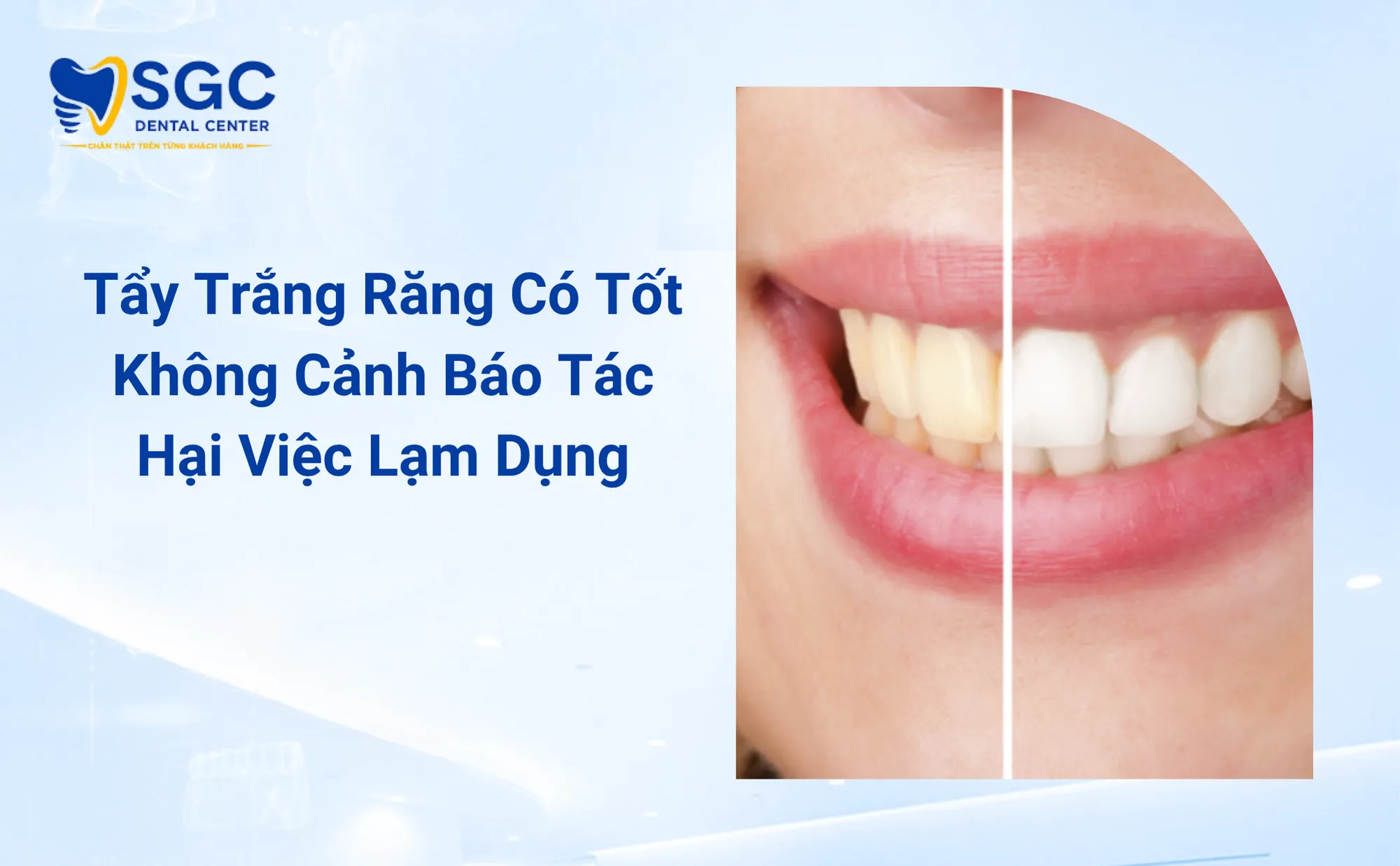 Tẩy Trắng Răng Có Tốt Không Cảnh Báo Tác Hại Việc Lạm Dụng