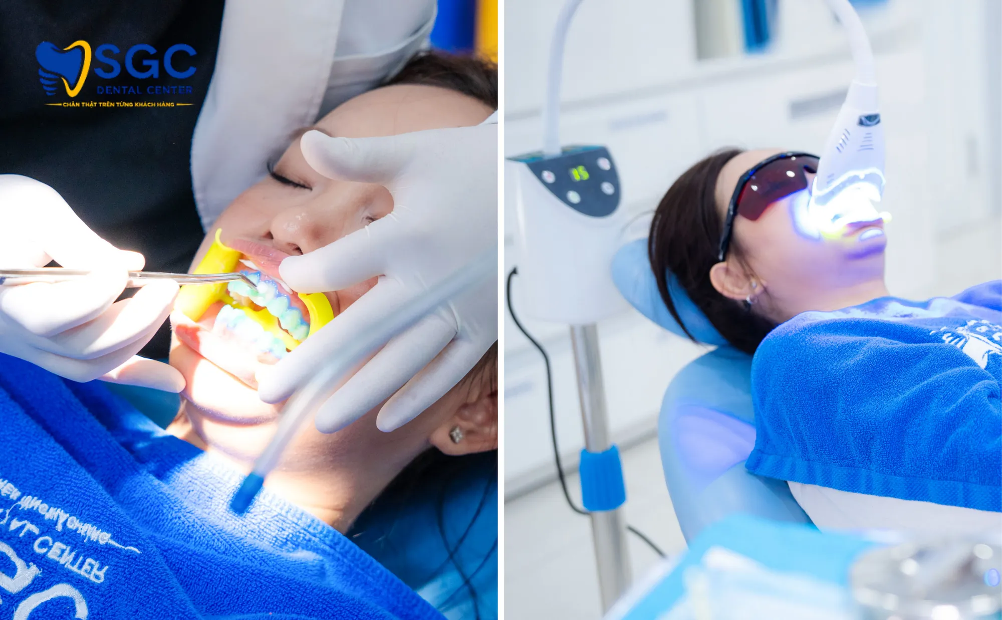 tay-trang-rang-laser-sgc