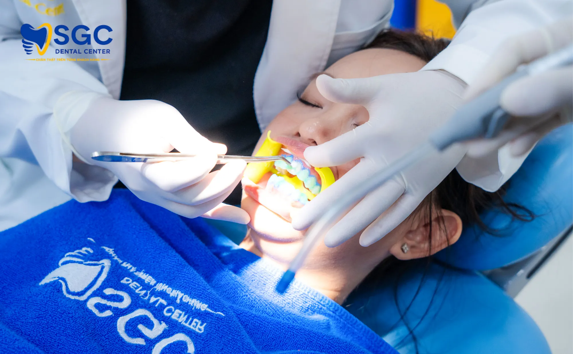 tay-trang-rang-laser-sgc