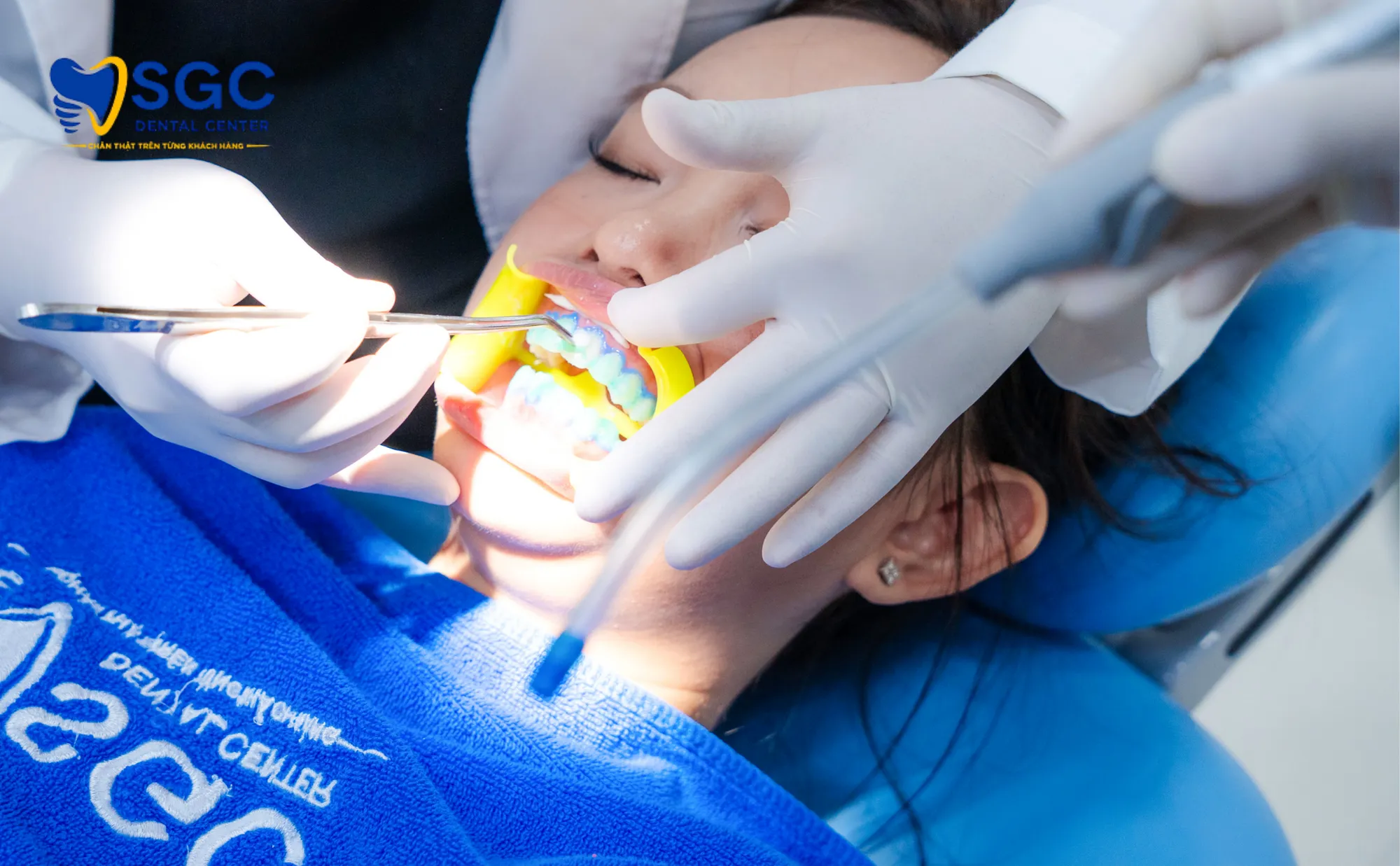 tay-trang-rang-laser-sgc