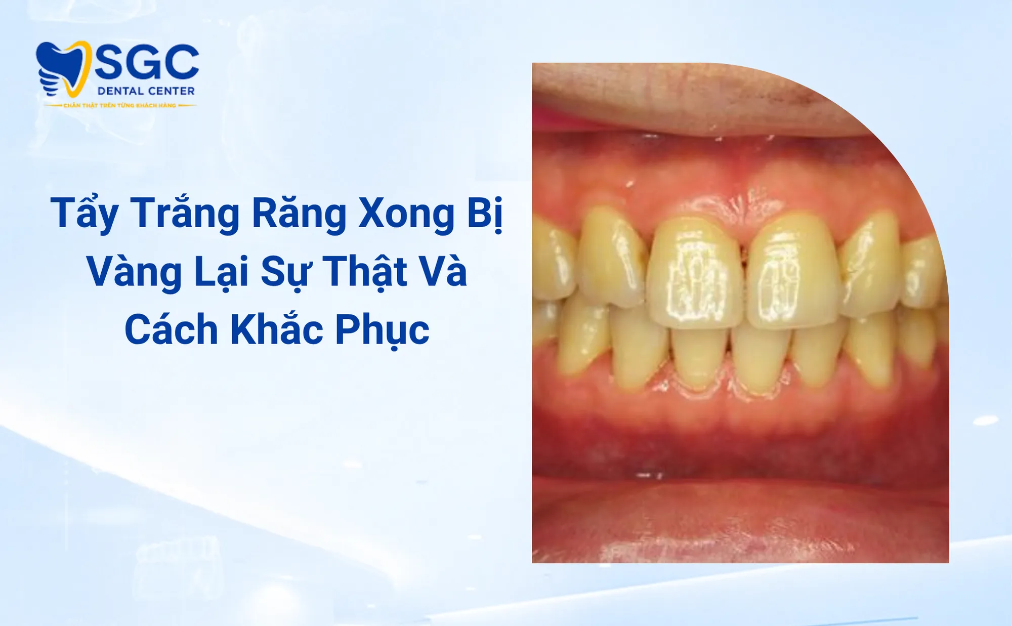 tay-trang-rang-xong-bi-vang-lai