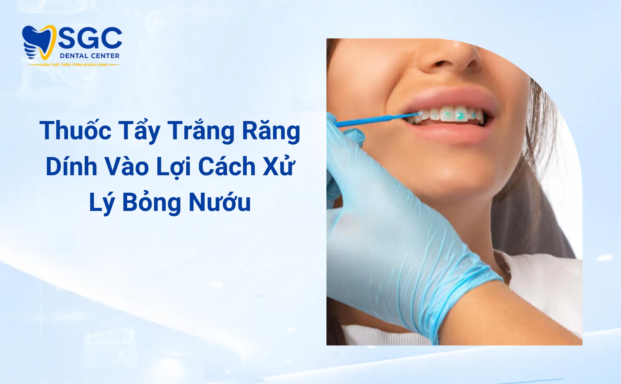 Thuốc Tẩy Trắng Răng Dính Vào Lợi Cách Xử Lý Bỏng Nướu