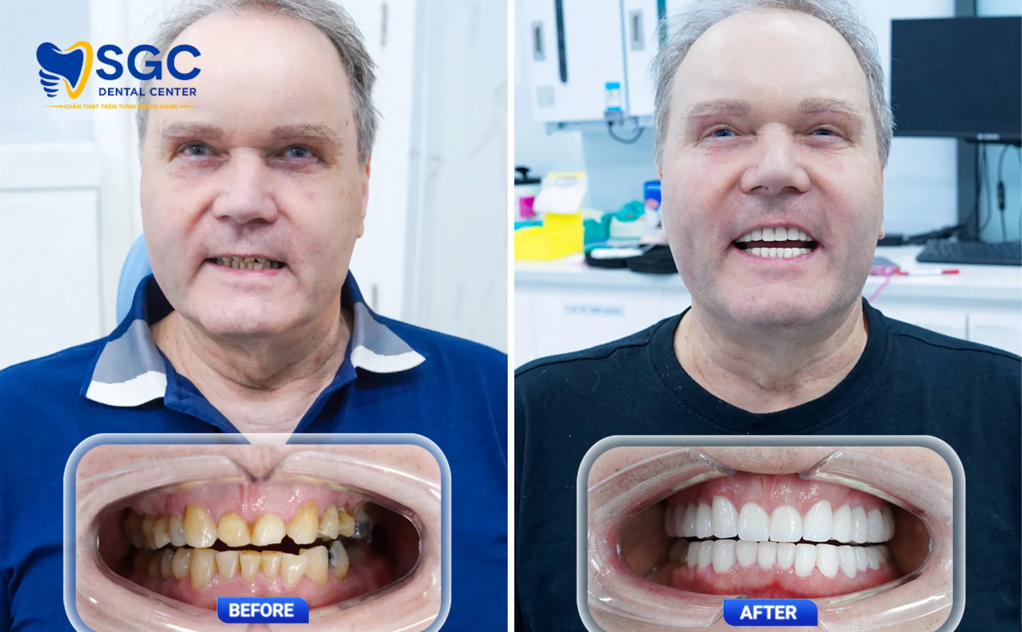 boc-rang-su-cho-rang-tram