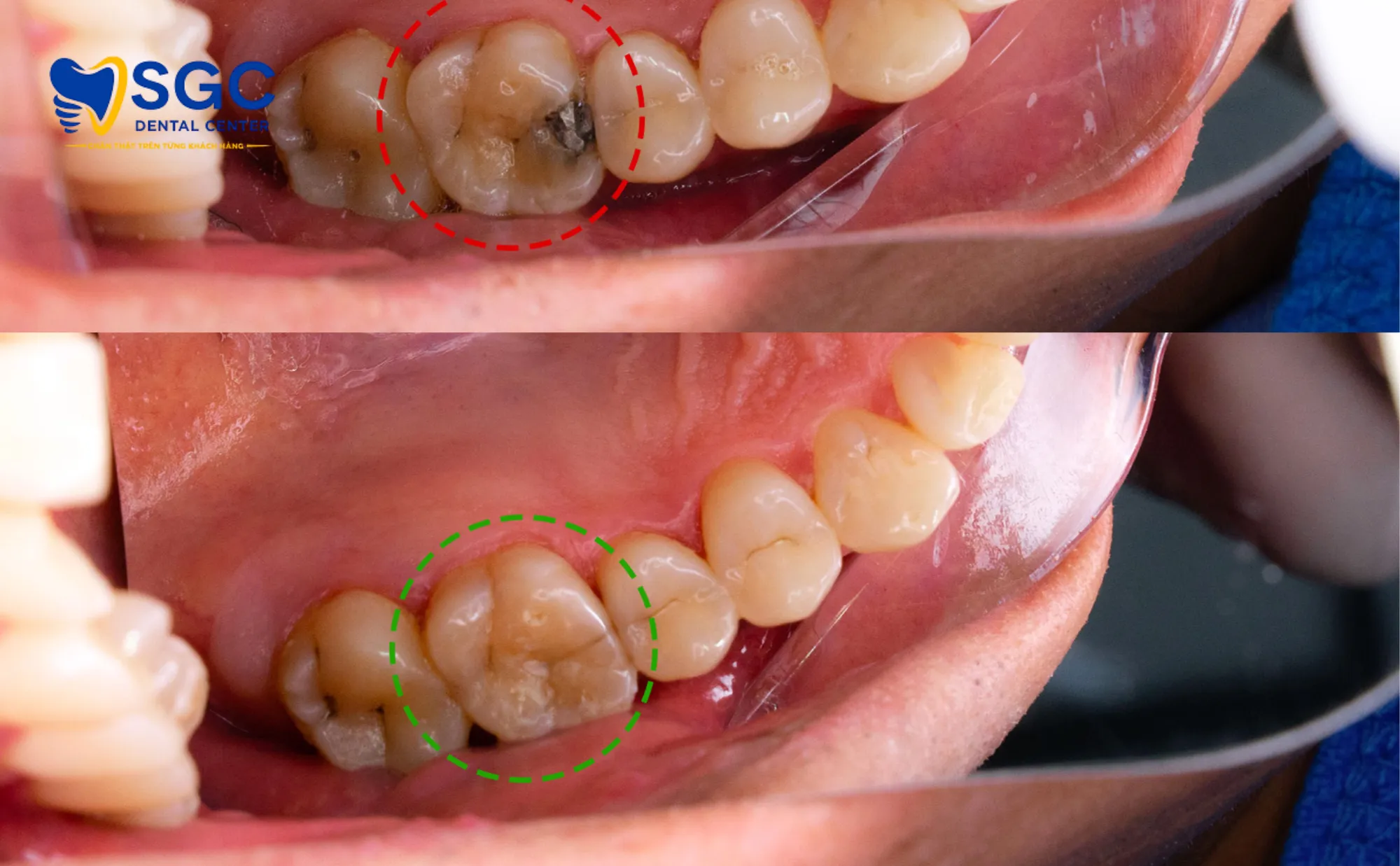 quy-trinh-tram-rang-tham-my